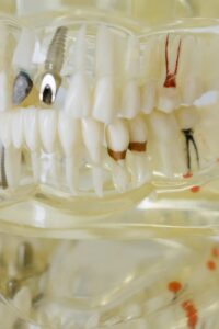 disease dental teeth model in close up photography